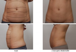 lifting médical du ventre sans chirurgie traitement ultherapy