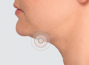 kybella