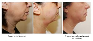 avant apres ultherapy