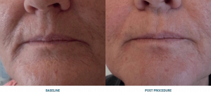 avant apres ultherapy