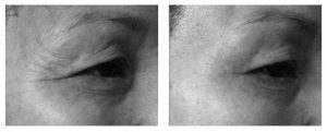 avant apres ultherapy