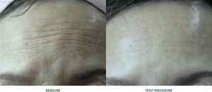 avant apres ultherapy