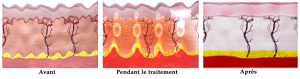 shema ultherapy